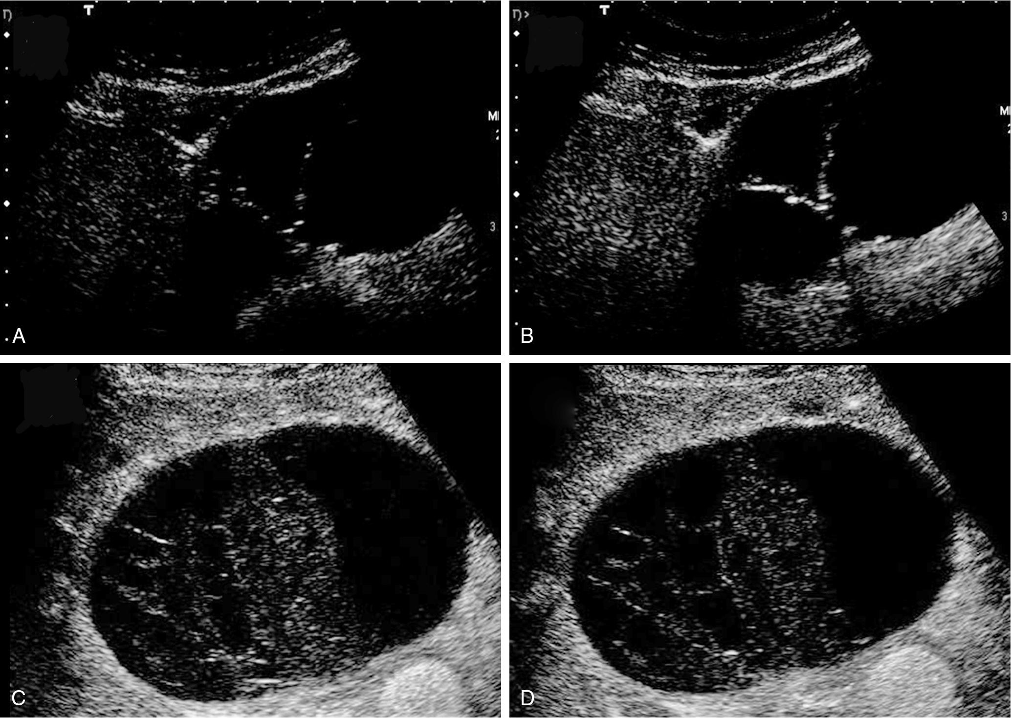 FIGURE 88B.5, Ultrasound (US) and contrast US of a cystadenoma with ovarian-like stroma (A and B) and of a hemorrhagic simple cyst (C and D) . Normal US (A and C) and contrast US (B and D) are shown. The septa are enhanced in the cystadenoma, but in hemorrhagic cysts, the intracystic material corresponds to clots and does not enhance (see Chapter 14 ).