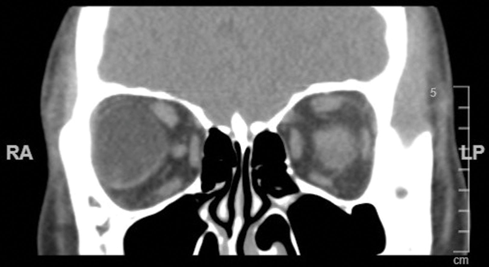 Fig. 27.3, A coronal computed tomography scan of a teenage girl with a large dermoid cyst largely within the right lateral rectus muscle.