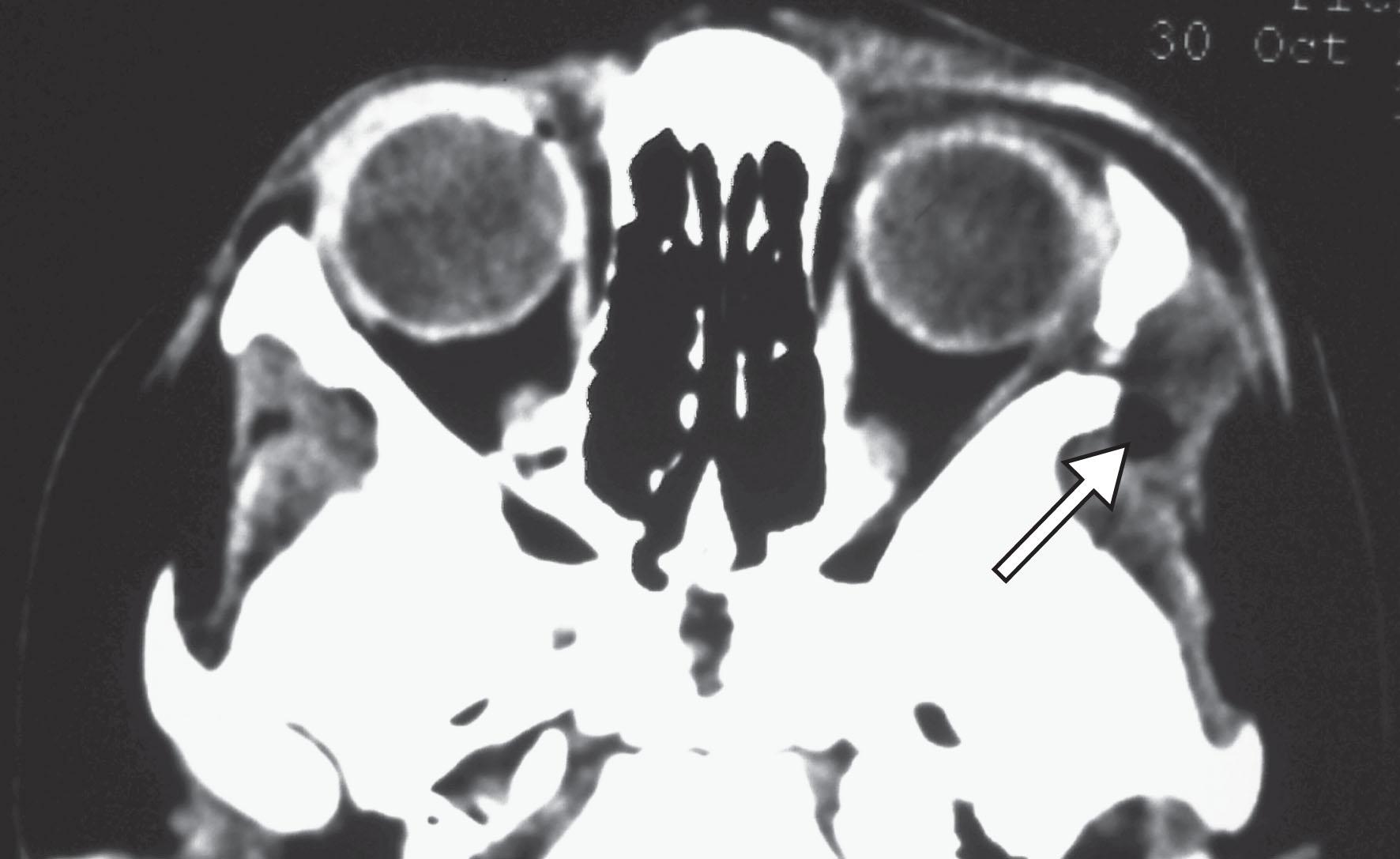 Fig. 27.4, An axial computed tomography scan of a “dumbbell” dermoid cyst with low-density contents extending through a defect behind the lateral orbital rim to involve both the orbit and temporal fossa (arrow).