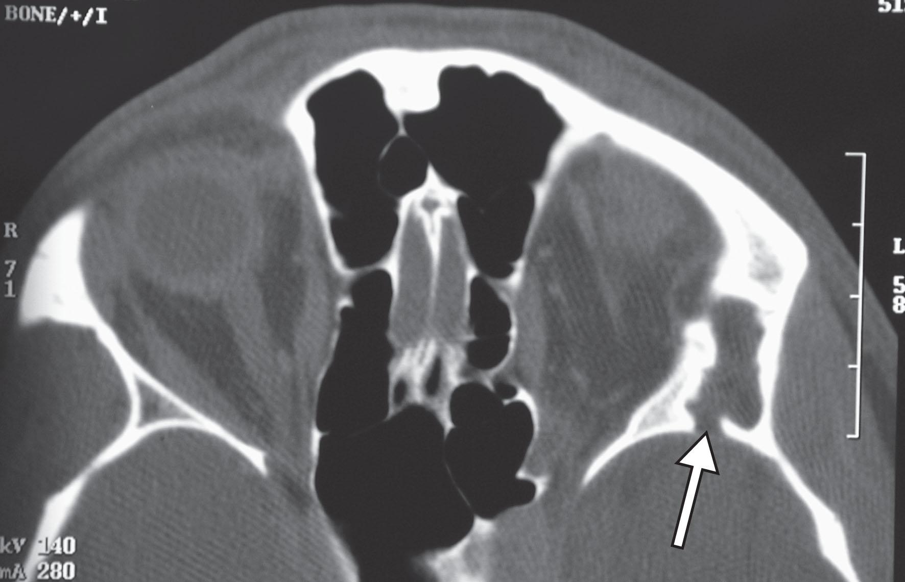 Fig. 27.5, Computed tomography axial scan of deep dermoid, showing the presence of irregular orbital wall defects (arrow).