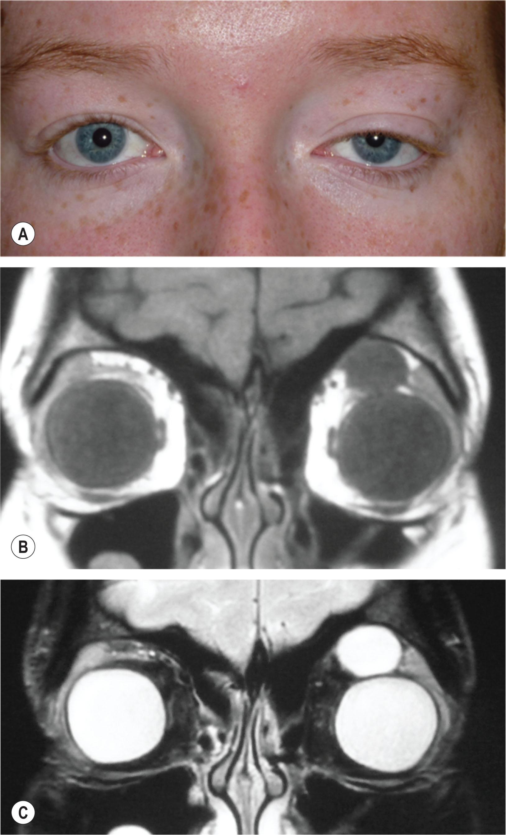 Fig. 27.6, (A) A teenage girl with longstanding left upper eyelid ptosis and inferior globe dystopia due to a superior orbital dermoid cyst. (B) Coronal T1-weighted magnetic resonance imaging shows the dermoid cyst contents to be of low signal, similar to vitreous. (C) On T2-weighted magnetic resonance imaging the cyst contents are of high signal and iso-intense with vitreous.