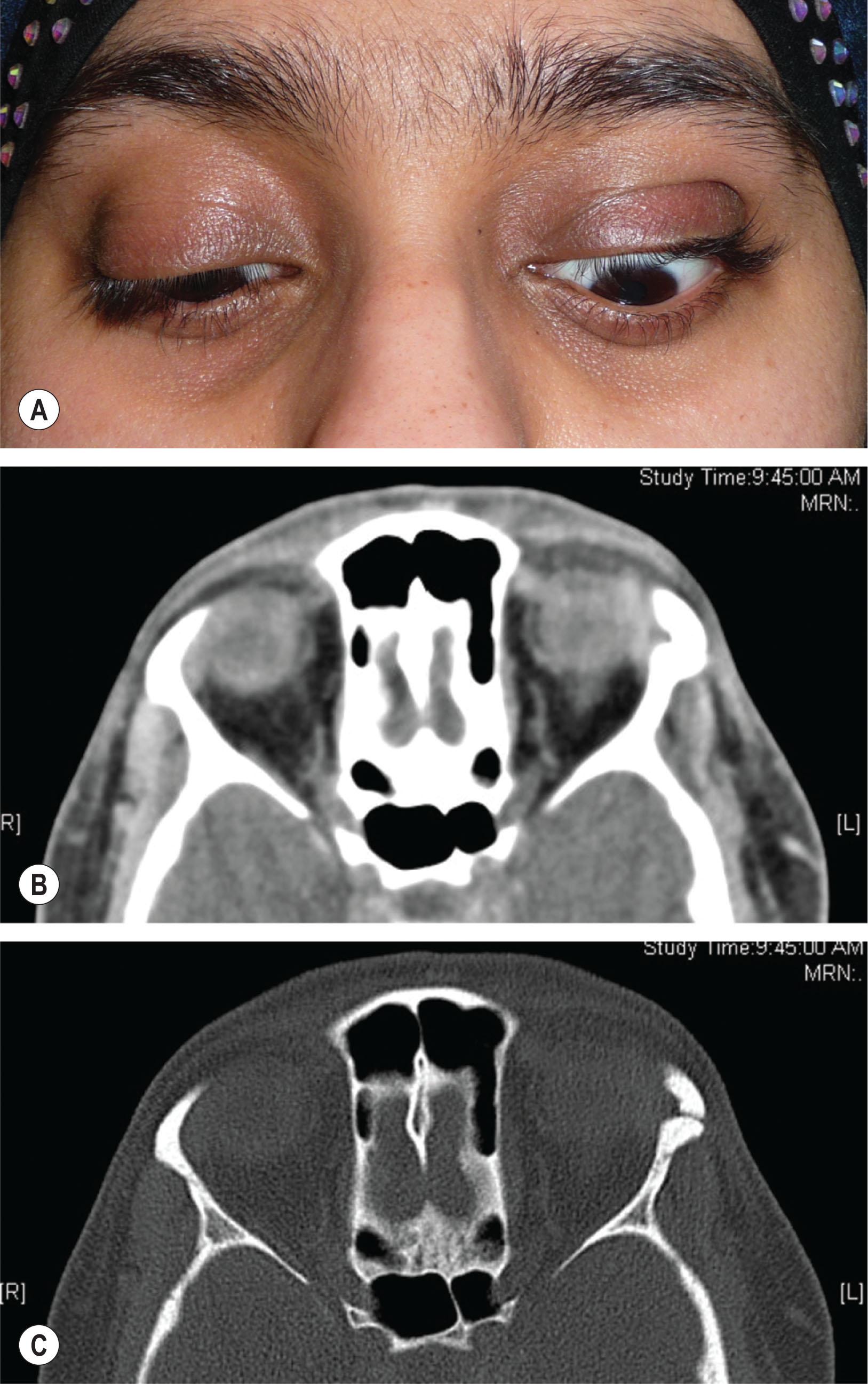 Fig. 27.7, An 18-year-old girl had undergone incomplete removal of a lateral orbital dermoid, leading to a discharging fistula, recurrent infection, and upper lid lag on downgaze due to scarring. (B) An axial computed tomography scan shows a small residual dermoid cyst adjacent to a bone defect. (C) An axial bone-window setting shows a small defect in the lateral orbital rim. There was a small amount of dermoid in the adjacent temporal fossa.