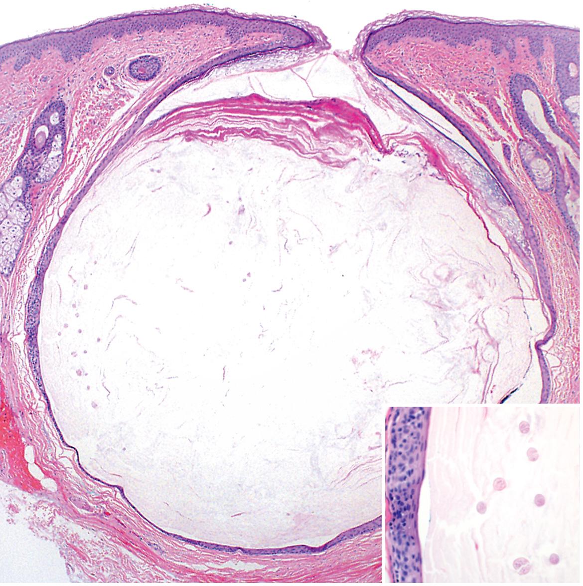 Fig. 110.12, Histology of a vellus hair cyst.