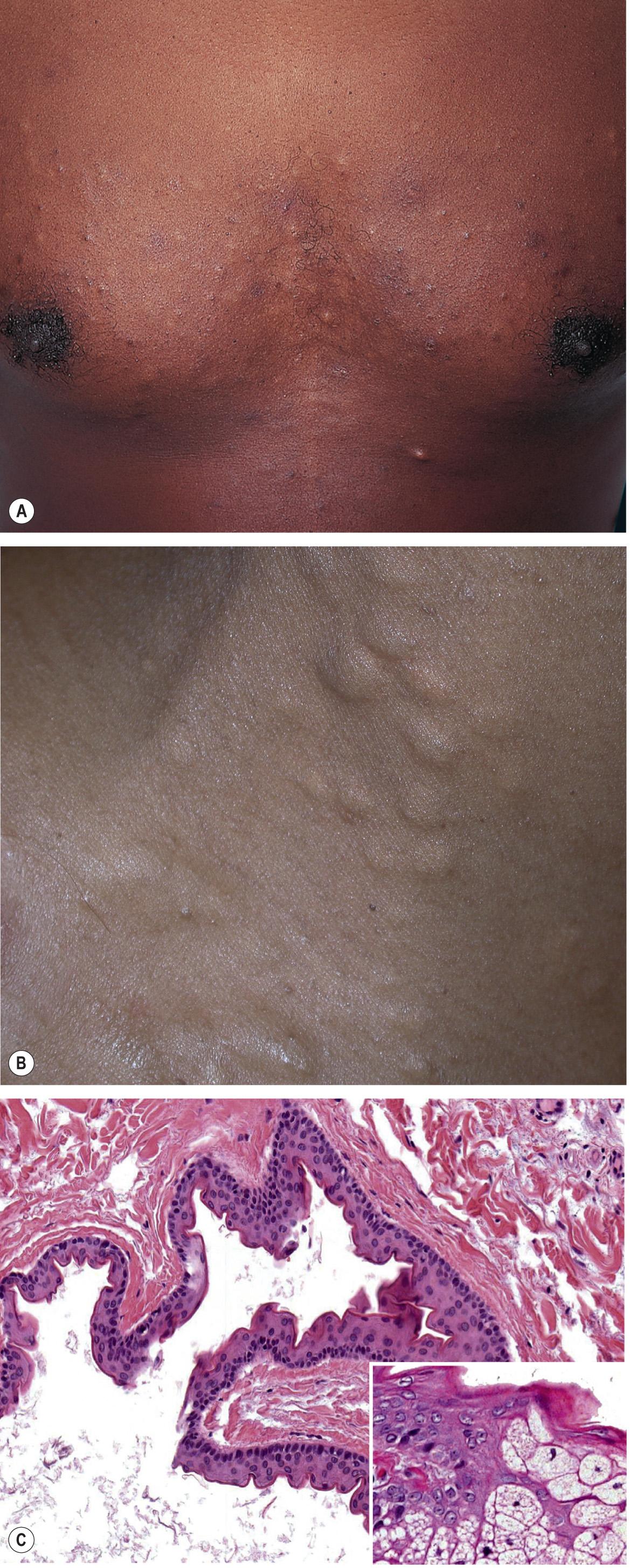 Fig. 110.13, Steatocystoma multiplex.