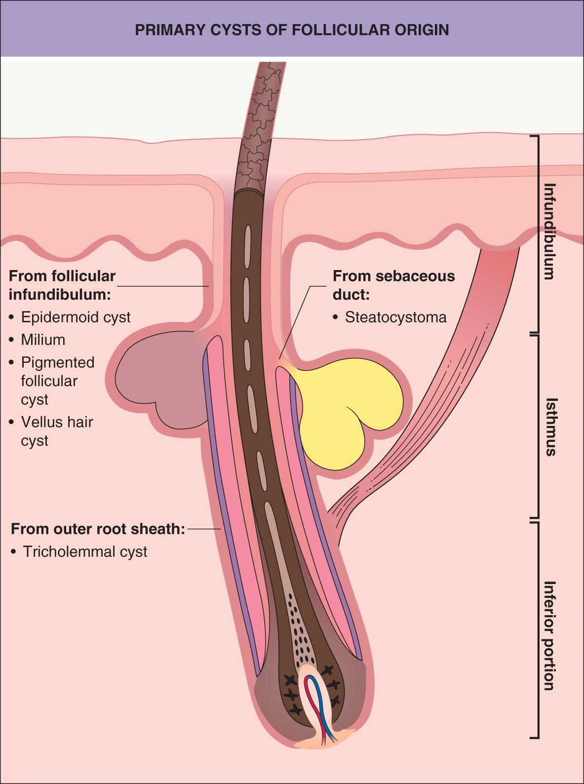 Fig. 110.3, Primary cysts of follicular origin.