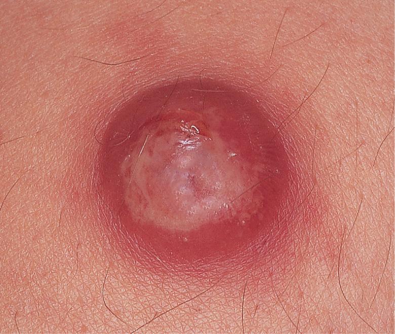 Fig. 110.5, Inflamed epidermoid cyst.