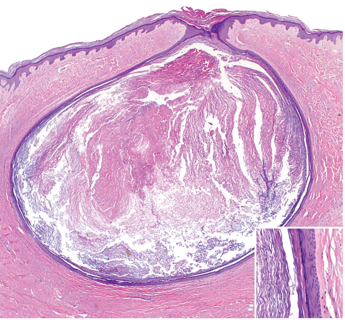 Fig. 110.6, Histology of an epidermoid cyst.