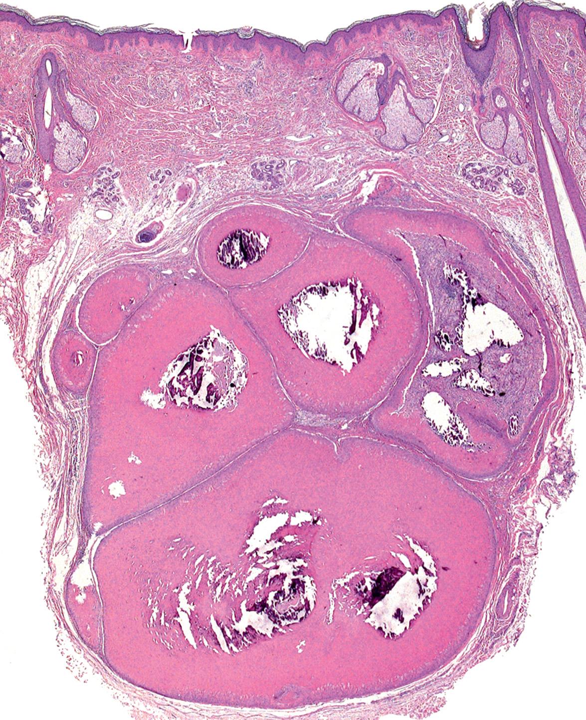 Fig. 110.10, Histology of a proliferating tricholemmal cyst.