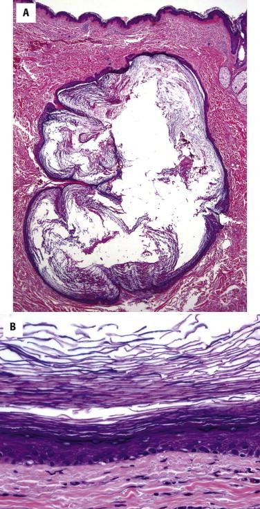 FIGURE 9-2, Epidermoid cyst: microscopic features. A, Epidermoid cysts are located in the dermis and contain laminated keratin. B, The cyst lining has an inner granular layer composed of keratinocytes with keratohyaline granules.