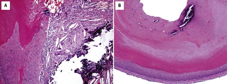 FIGURE 9-12, Trichilemmal cyst: secondary microscopic features. A, A foreign body giant cell reaction is elicited to extravasated keratin from a ruptured trichilemmal cyst. B, Calcifications are a frequent finding.