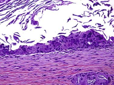 FIGURE 9-3, Epidermoid cyst: microscopic features. A ruptured epidermoid cyst results in a foreign body giant cell reaction to extravasated keratin.