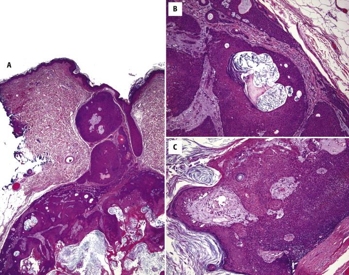 FIGURE 9-5, Proliferating epidermoid cyst: microscopic features. A, A proliferating epidermoid cyst has cellular lobules of squamous cells that radiate peripherally from a central cyst, but the periphery of the lesion is well circumscribed. B, Infundibular (epidermoid) keratinization occurs where cysts are formed. C, Small balls of keratinocytes (squamous eddies) are often seen in the cellular areas of the lesion.