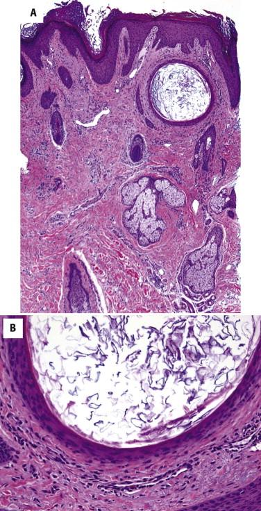 FIGURE 9-8, Milium: microscopic features. A, A small cyst is located in the superficial dermis. B, The epithelial lining has a thin inner granular layer, forming laminated keratin, and is histologically indistinguishable from an epidermoid cyst.