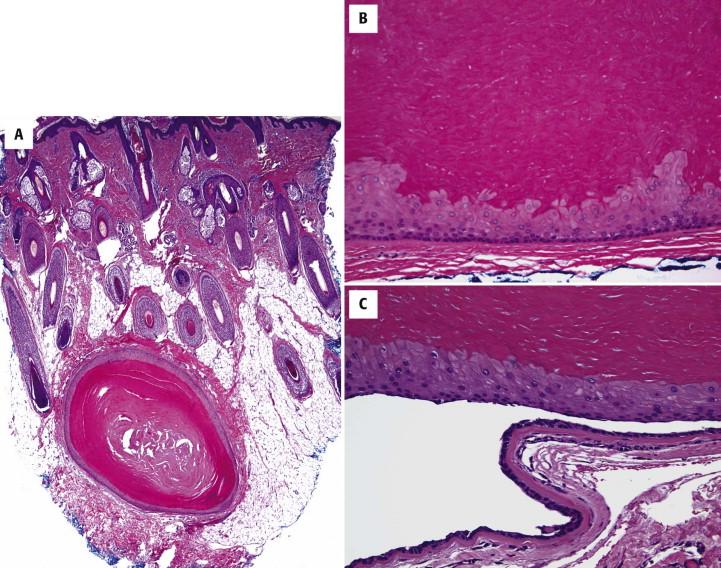 FIGURE 9-11, Trichilemmal cyst: microscopic features. A, Trichilemmal cysts are located in the dermis or subcutis and the cysts are filled with dense eosinophilic keratin. B, Trichilemmal keratinization occurs abruptly from large eosinophilic keratinocytes. C, The outer layer of trichilemmal cysts has a tendency to separate from the remainder of the cyst epithelium.