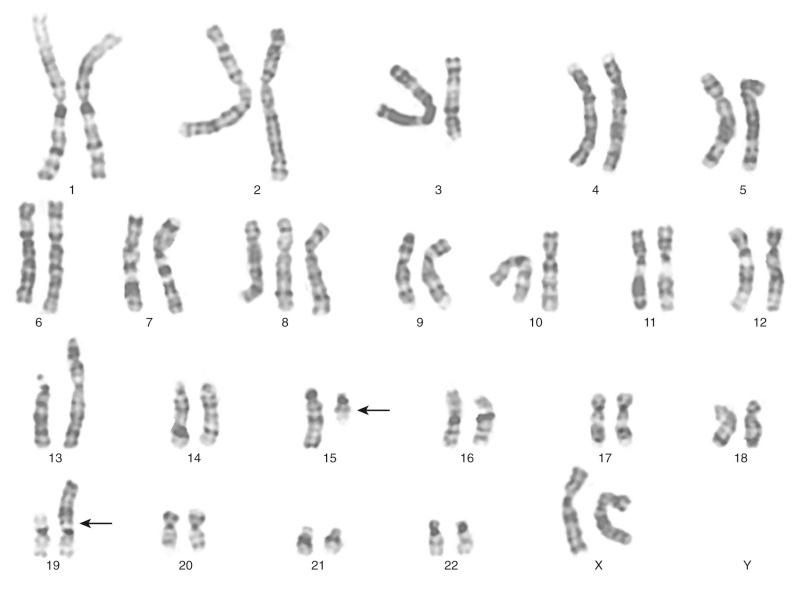 Figure 45-1, Giemsa-banded karyotype of highly lethal NUT midline carcinoma, demonstrating balanced t(15;19) with arrows indicating the translocation breakpoints. Other cytogenetic findings, including chromosome 3 and 13 rearrangements and trisomy 8, are secondary aberrations.