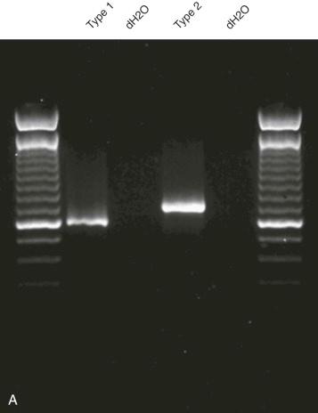 Figure 45-11, Reverse-transcriptase polymerase chain reaction (RT-PCR) demonstration of various TPM4-ALK fusion oncogene transcripts in inflammatory myofibroblastic tumors, as distinguished by gel electrophoresis of PCR products generated with the same primers (A) , with primer hybridization sites as indicated (B) .