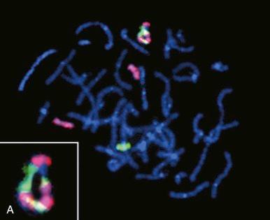 Figure 45-13, A, Fluorescence in situ hybridization (FISH), with whole chromosome “painting” probes to chromosomes 17 (pink) and 22 (green), demonstrates alternating segments of chromosomes 17 and 22 in a dermatofibrosarcoma protuberans ring chromosome (magnified in inset), resulting in threefold amplification of the characteristic COL1A1-PDGFB fusion oncogene. B, FISH demonstration of highly amplified and rearranged FOXO1 gene (green) in an alveolar rhabdomyosarcoma with PAX7-FOXO1 oncogenic fusion. Break-apart probe components 5′ and 3′ to the FOXO1 gene are red and green, respectively. Normal fibroblast nucleus at upper left contains two normal fusion probe signals.