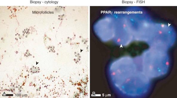 Figure 45-14, A, Cytology and B, fluorescence in situ hybridization (FISH) of follicular thyroid carcinoma, demonstrating rearrangement of the PPARγ gene, using break-apart probe, in microfollicle cells.