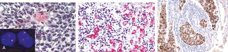 Figure 45-15, A, NUT midline carcinoma (sinonasal primary) composed of undifferentiated rounded cells with focal keratinization (arrow). Inset, BRD4 break-apart fluorescence in situ hybridization reveals rearrangement. Immunohistochemical study demonstrates reactivity for pan-keratin (B), indicating epithelial differentiation (alkaline phosphatase red). The NUT protein (C) (peroxidase DAB) is expressed in tumor cells but not in admixed histiocytes and lymphocytes.