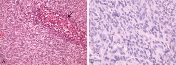 Figure 45-16, A, Congenital mesoblastic nephroma and B, infantile fibrosarcoma are histologically indistinguishable tumors composed of mitotically active plump spindle cells, with varying extent of fascicular arrangement and showing islands of spontaneous necrosis as a characteristic feature (arrow).