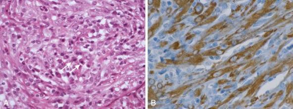 Figure 45-17, A, Inflammatory myofibroblastic tumor composed of plump neoplastic spindle cells with a reactive infiltrate featuring abundant plasma cells (arrows). B, Immunohistochemistry in a case with TPM4-ALK fusion, showing diffuse cytoplasmic staining with nuclear sparing in spindle cell (myofibroblastic) component and absence of immunoreactivity in the inflammatory cell infiltrate.