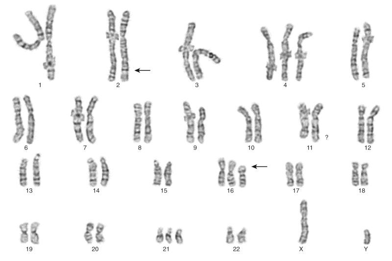 Figure 45-18, Ewing sarcoma with t(2;16)(q35;p11), resulting in oncogenic fusion of the FEV1 and FUS genes ( arrows indicate translocation breakpoints).