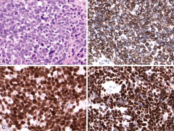 Figure 45-20, Solid variant of alveolar rhabdomyosarcoma composed of undifferentiated, moderately pleomorphic round cells histologically (A) , but with convincing evidence of myogenic differentiation, as demonstrated by strong and diffuse cytoplasmic expression of desmin (B) and nuclear reactivity for MyoD1 (C) and myogenin (D) . Of note, the percentage of nuclei reacting for both myogenin and MyoD1 is very high, as is typical of the alveolar variant of rhabdomyosarcoma.