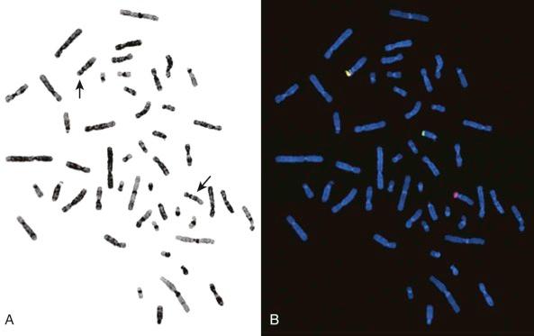 Figure 45-2, A, Giemsa banding studies in infantile fibrosarcoma do not reveal the characteristic, but cytogenetically cryptic t(12;15), associated with TEL-NTRK3 oncogenic fusion. Black arrows indicate the normal (top) and rearranged (middle) copies of chromosome 12, as demonstrated by TEL break-apart fluorescence in situ hybridization (FISH). B, The FISH studies reveal yellow probe fusion signal on the normal chromosome 12, whereas the t(12;15) results in split red and green FISH signals on rearranged chromosomes 12 and 15, respectively.