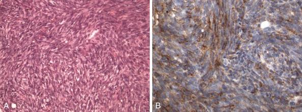 Figure 45-21, A, Monophasic synovial sarcoma, with interdigitating fascicular arrangement of fusiform spindle cells. B, Weak, patchy immunohistochemical staining for epithelial membrane antigen (EMA) in the spindle cells.