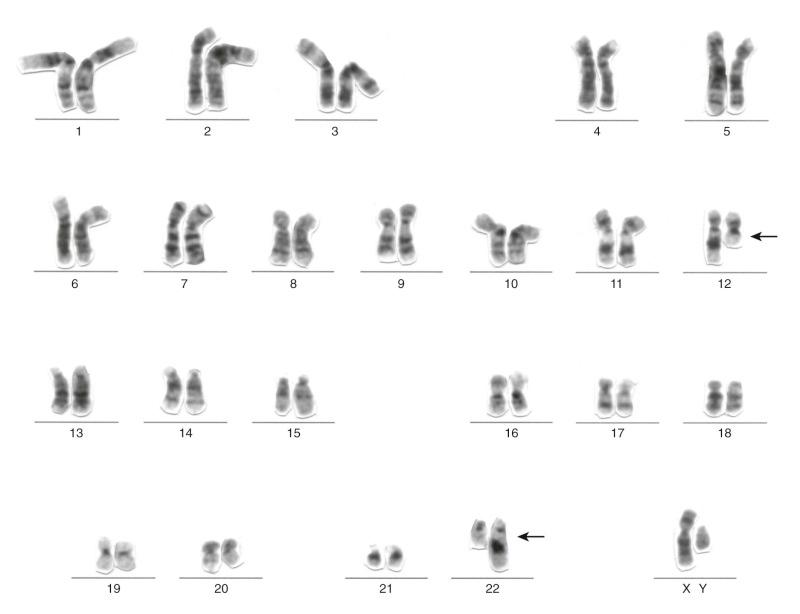 Figure 45-22, Clear cell sarcoma karyotype showing balanced translocation, t(12;22), as the only cytogenetic aberration. Arrows indicate translocation breakpoints.