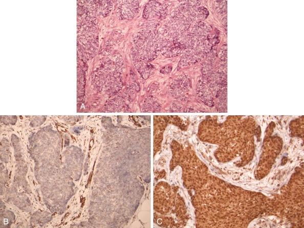 Figure 45-23, A, Desmoplastic small round cell tumor with sharply demarcated islands of blue tumor cells separated by pink densely fibrotic “desmoplastic” stroma. Immunoreactivities with antibodies to N-terminal (B) and C-terminal (C) regions of WT1 are negative and strongly positive, respectively, in the tumor cells, in keeping with EWS-WT1 fusion oncoprotein expression.