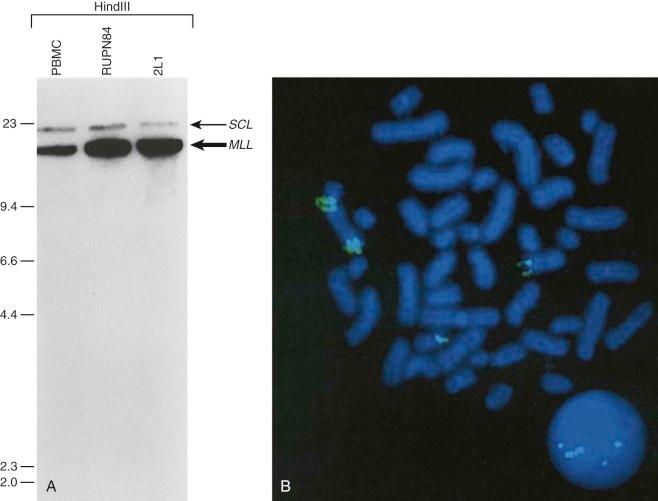 Figure 45-4, A, Southern blot analysis indicating MLL gene amplification in treatment-related acute myelogenous leukemia (AML). Southern blot analysis of HindIII- digested genomic DNA from French-American-British M4 AML cells (RUPN84) of a patient whose AML karyotype showed no evidence of chromosome band 11q23 rearrangement that would suggest MLL gene rearrangement and a cell line established from the same AML (2L1). Cohybridization with a MLL bcr-region probe and a loading control SCL probe demonstrates unrearranged but amplified MLL with signal intensity of 4.3 : 1 in the AML compared with normal peripheral blood mononuclear cell (PBMC) control DNA. B, Fluorescence in situ hybridization confirms MLL genomic amplification in RUPN84.