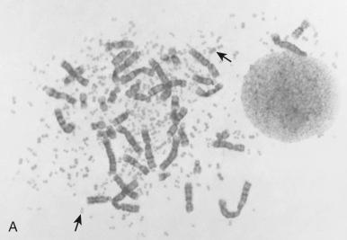 Figure 45-5, A, Giemsa-stained neuroblastoma metaphase cell (and with nucleus from a different cell on right) showing hundreds of variably sized double-minute chromosomes, as indicated by arrows. B, MYCN fluorescence in situ hybridization (FISH) evaluation of neuroblastoma metaphase cell, showing numerous extrachromosomal double minutes containing MYNC (green) whereas the reference chromosome 2 pericentromeric FISH probe (red) shows two copies.