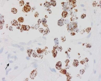 Figure 45-6, MYCN chromogenic in situ hybridization in a neuroblastoma paraffin section. Peroxidase-DAB detection (brown) of MYCN fluorescence in situ hybridization probe demonstrates high-level MYCN amplification in neuroblastoma cells but not in fibrovascular nonneoplastic cells (arrow).