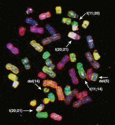 Figure 45-7, Metaphase spectral karyotype in treatment-associated acute myelogenous leukemia, showing typical 5q deletion, among other clonal aberrations.