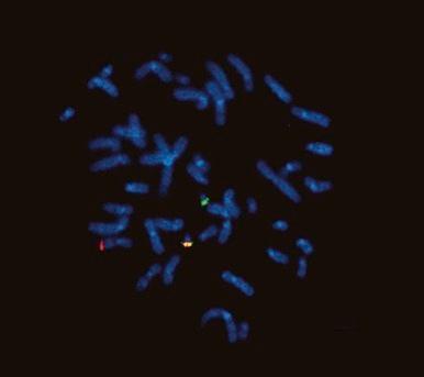 Figure 45-8, EWS break-apart fluorescence in situ hybridization probe, hybridized to Ewing sarcoma metaphase cell, in which probe components centromeric and telomeric to EWSR1 are detected with fluorescein isothiocyanate (green) and rhodamine (red), respectively. EWSR1 rearrangement is indicated by the breaking apart of the normal yellow ( green-red fusion) signal into the red and green components, which localize to different chromosomes as a result of translocation.