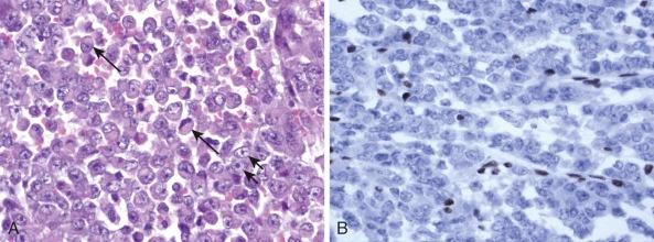 Figure 45-9, A, Rhabdoid tumor showing loosely cohesive cells, many containing intracytoplasmic inclusions (arrows). Nuclei are vesicular and contain prominent nucleoli (short arrows) (H&E stain). B, INI1 immunohistochemistry, showing entirely negative reaction in the neoplastic cells, reflecting loss of 22q, and with only the endothelial and occasional admixed inflammatory cells staining positively.