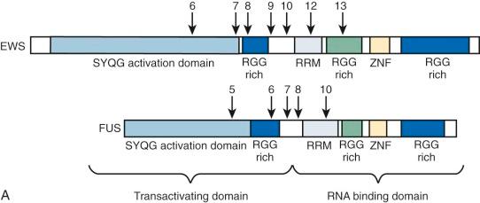 Figure 45-10, A, EWS and FUS genes encode an N-terminal transcriptional activation domain, RGG-rich regions, RNA recognition motif, and a zinc finger. Arrows indicate various breakpoints reported in EWS or FUS oncogenes. B (top) , Domains encoded by the various ETS-family genes fused with EWS or FUS in Ewing sarcoma. Arrows indicate various breakpoints that have been reported in fusion rearrangements. The most common oncogenic rearrangements in Ewing sarcoma involve the fusion of the EWS exon 7 to FLI1 exon 6 (type 1 transcript) or exon 5 (type 2 transcript). B (bottom) , Domains encoded by the WT1 gene, which is fused with EWS in desmoplastic small round cell tumor. Two WT1 isoforms are produced by an alternative spicing event (±KTS) between zinc fingers 3 and 4. C (top) , Domains encoded by oncogenic fusions between EWS or FUS with an ETS family member in Ewing sarcoma. Dotted lines indicate regions that are variably included, depending on the breakpoint locations. C (bottom) , Domains encoded by the EWS-WT1 fusion oncogene in desmoplastic small round cell tumor. Dotted lines indicate encoded sequences that are variably included, depending on the breakpoint locations (RGG-rich region) and alternative splicing events (KTS). D, Reverse-transcriptase polymerase chain reaction demonstration of type 1 EWS-FLI1 transcript in Ewing sarcoma (lane 1). Positive controls for types 1 and 2 transcripts are in lanes 3 and 4, respectively.