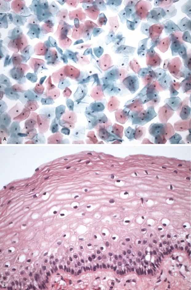 FIG. 21.1, Normal cytology (A) and histology (B) of the ectocervical epithelium in cycling women. Cytologic sampling obtains cells from the most superficial two to three layers, and hence, superficial and intermediate cells are the only cell types obtained.