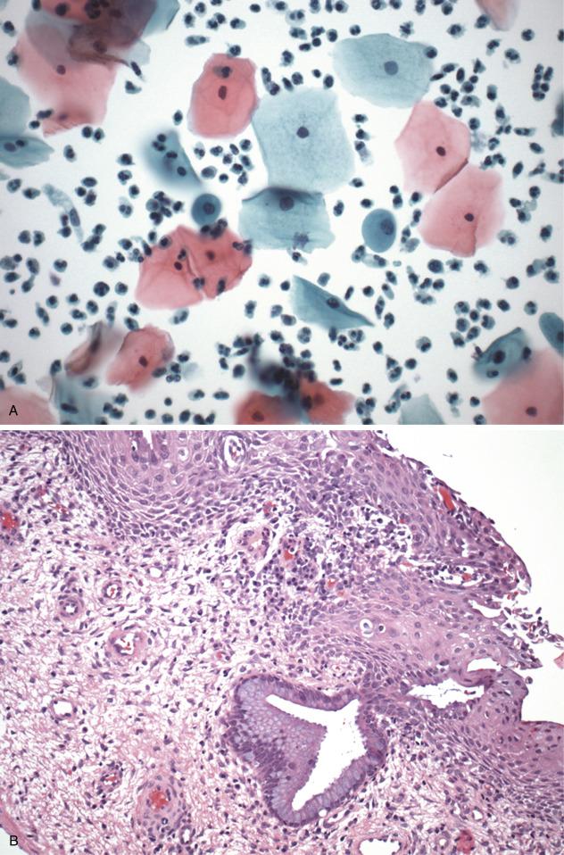 FIG. 21.2, Normal cytology (A) and histology (B) of transformation zone epithelium. In addition to superficial and intermediate cells, the presence of squamous metaplastic cells (small, round, and dense cytoplasm) indicates that this biologically important area, where human papillomavirus infects the cervix, has been sampled.