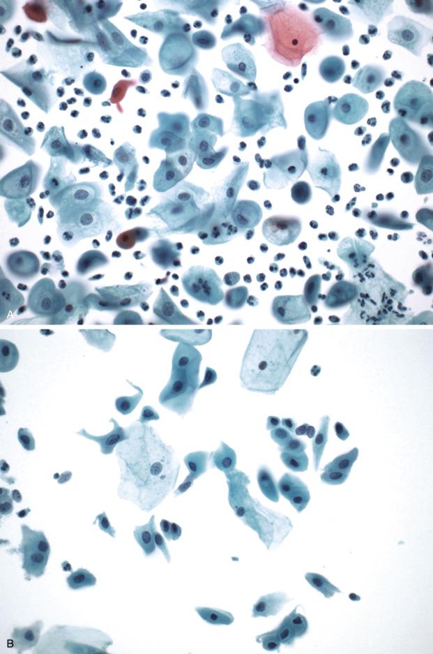 FIG. 21.3, Atrophy. In patients with mucosal atrophy, the cytology shows predominantly small immature squamous cells (A), which may be present in isolated form (B) or in dense groups (C). When present in groups, these cells can be mistaken for high-grade squamous intraepithelial lesions. The histology of atrophy shows a very thin squamous epithelium with little or no maturation to the surface (D).