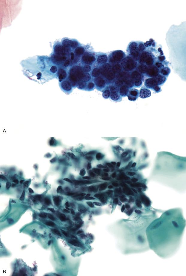 FIG. 21.5, Benign endometrial epithelium. Benign exfoliated endometrial cells present as three-dimensional clusters of uniform small cells, occasionally showing vacuoles or evidence of degeneration (A). Endometrial stromal cells present as loosely arranged groups with wispy, elongated cytoplasmic appendages (B). In menstrual specimens, degenerating three-dimensional groups of endometrial epithelium (outer layer) and stroma (inner core) can be present in cytologic (C) and histologic (D) specimens.