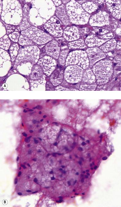 Figure 18-1, Hibernoma. (A) Histologic section. Adipocytes with multivacuolated cytoplasm (H&E, ×LP). (B) Smear. Round cells with small cytoplasmic vacuoles and small, round nuclei and delicate branching capillaries present (H&E, ×MP).