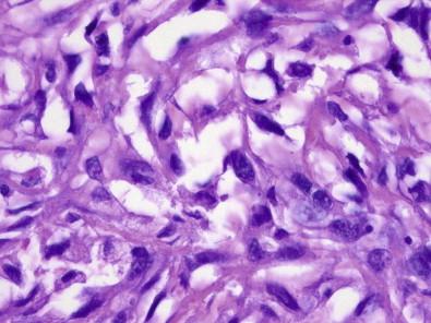 Figure 18-11, Epithelioid leiomyosarcoma. Tissue section of epithelioid leiomyosarcoma. Here the vacuolated cytoplasm is obvious (H&E, ×HP).