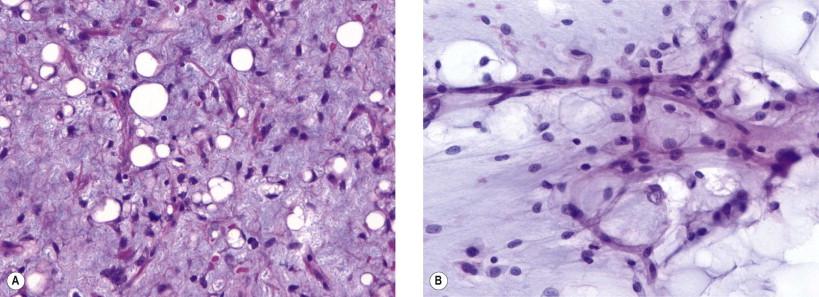 Figure 18-2, Myxoid liposarcoma. (A) Histologic section. Uniform population of round to oval-shaped cells present in a myxoid stroma associated with a vascular network with a “chicken-wire” appearance (H&E, ×LP). (B) Smear. Myxoid background matrix, plexiform vascular network, cells with round to ovoid nuclei (Papanicolaou, ×MP).