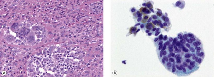 Figure 18-4, Giant cell tumor of tendon sheath. (A) Histologic section: population of mononuclear cells, giant multinucleated cells, macrophages, hemosiderin-laden macrophages and stroma (H&E, ×LP). (B) Smear. Osteoclast-type giant cells and mononucleated cells (Papanicolaou, ×MP).