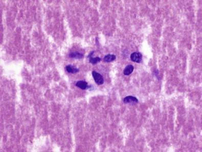 Figure 18-5, Leiomyoma. Cell block preparation of a superficial leiomyoma showing bland-appearing spindle-shaped cells with cytoplasm (H&E, ×MP).