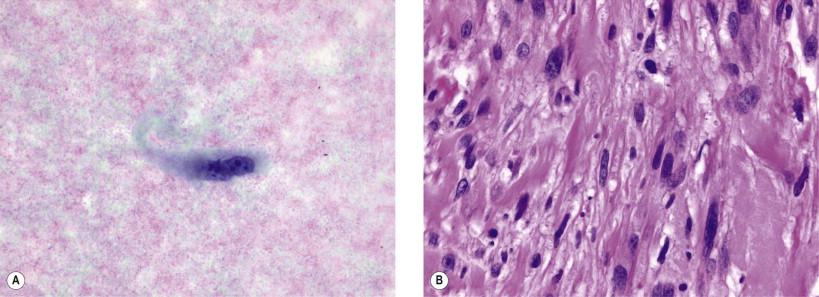 Figure 18-6, Leiomyosarcoma. (A) FNA biopsy of a deep tissue leiomyosarcoma. This single cell is characterized by a spindle shape with a markedly abnormal nucleus and prominent nucleoli (Papanicolaou, ×HP). (B) Corresponding tissue section of leiomyosarcoma with parallel bundles of elongate cells. Cells are pleomorphic with eosinophilic cytoplasm (H&E, ×MP).