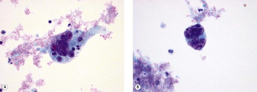 Figure 18-7, Leiomyosarcoma. Single pleomorphic cells of a high-grade leiomyosarcoma. Hyperchromasia and irregular nuclear contours are apparent. These smooth muscle tumor cells can mimic other sarcomas such as MFH (H&E, ×HP).