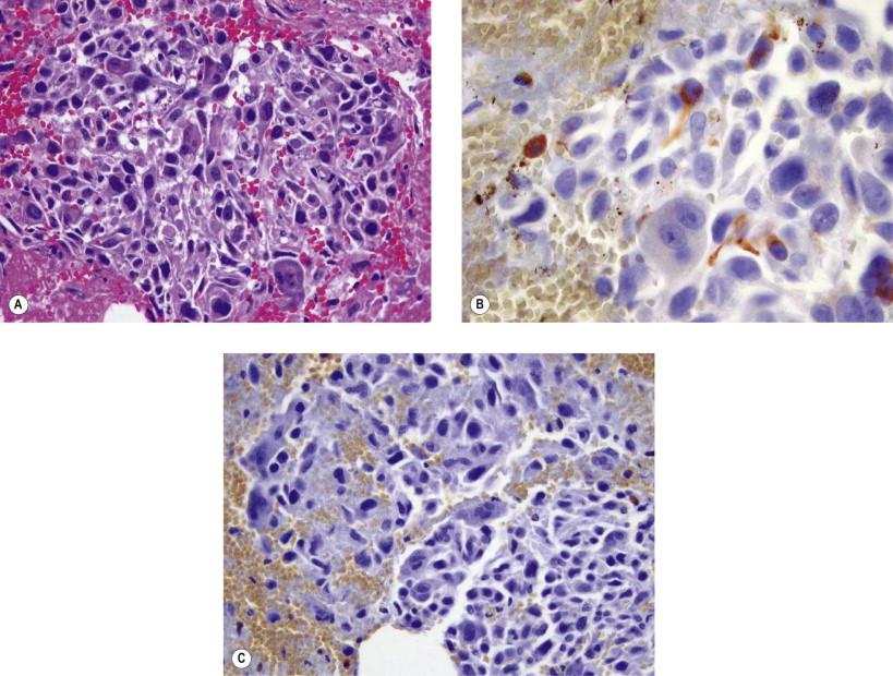 Figure 18-9, Epithelioid smooth muscle tumor. (A) Tissue section of epithelioid smooth muscle tumor (H&E, ×MP) showing cohesive arrangement, high N : C ratio, and abnormal, multinucleated cells. (B) Desmin-stained section of the tumor showing focal positivity. (C) This tumor is negative for AE1/3, supporting its muscle differentiation.